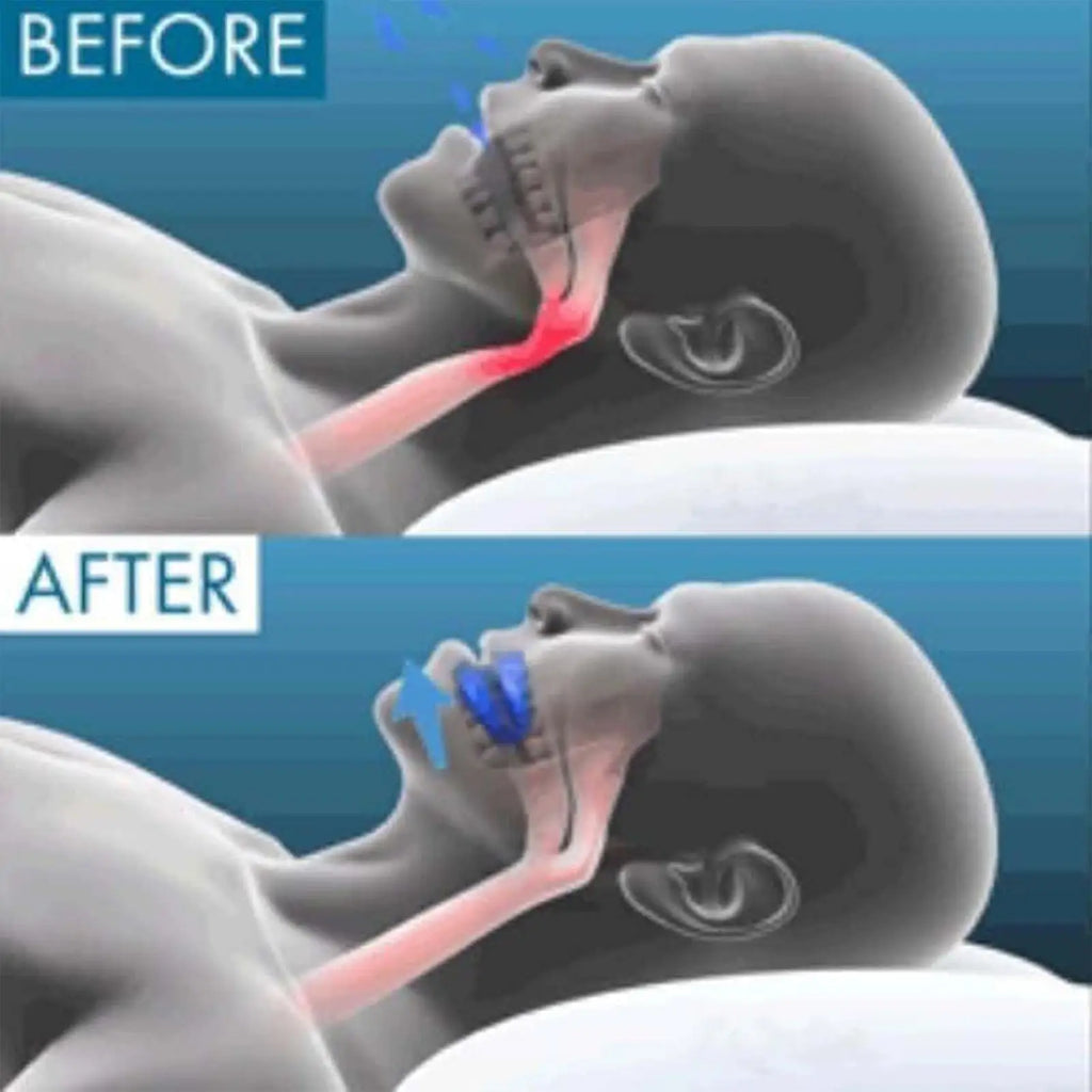 Anti Snoring Mouthpiece Reusable Snore Device Stopper Anti Snoring Mouth Guard Braces Sleeping Anti-Snoring Devices