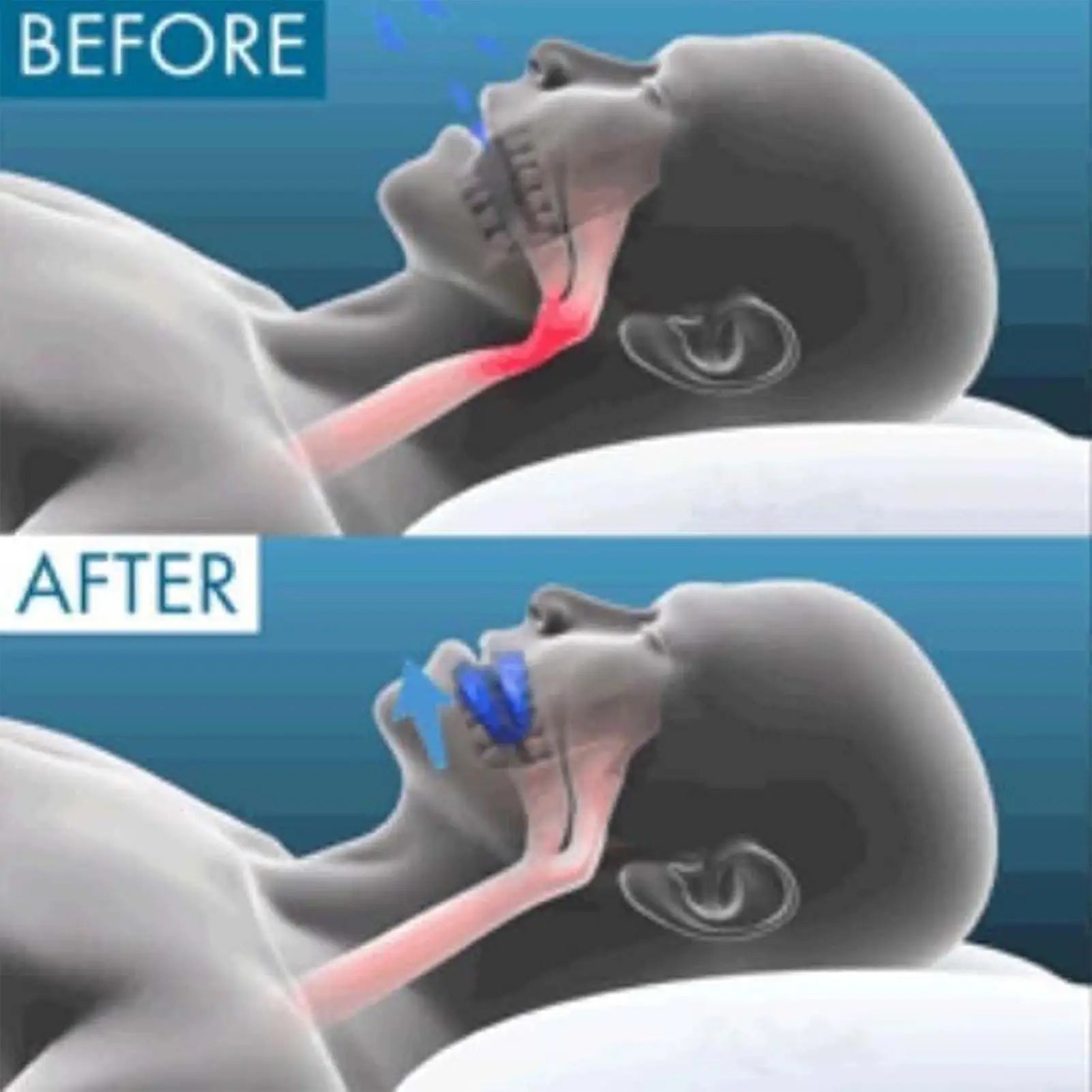 Anti Snoring Mouthpiece Reusable Snore Device Stopper Anti Snoring Mouth Guard Braces Sleeping Anti-Snoring Devices